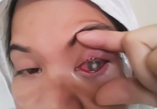 Trafficking victim being blinded